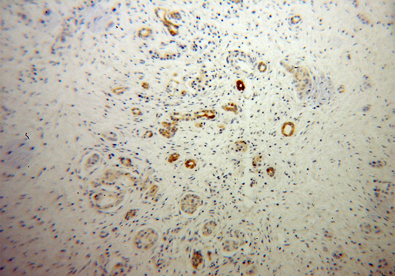 Immunohistochemical of paraffin-embedded human pancreas cancer using Catalog No:114274(PTH2R antibody) at dilution of 1:50 (under 10x lens)