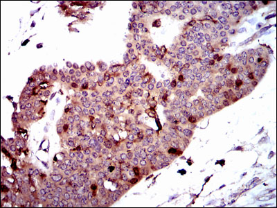 Immunohistochemical analysis of paraffin-embedded ovarian cancer tissues using PBK mouse mAb with DAB staining.
