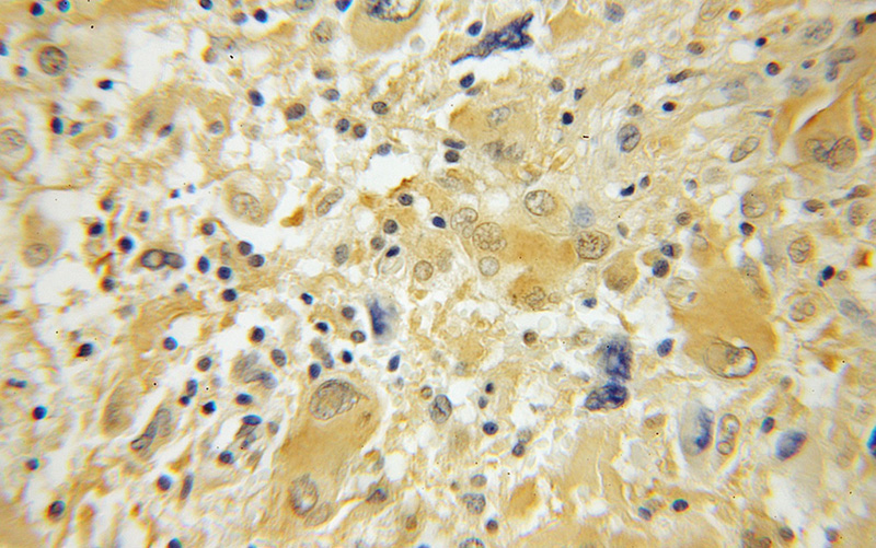 Immunohistochemical of paraffin-embedded human medulloblastoma using Catalog No:107758(ACYP2 antibody) at dilution of 1:50 (under 10x lens)