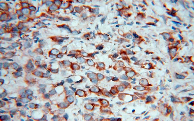 Immunohistochemical of paraffin-embedded human prostate cancer using Catalog No:107899(AEG-1 antibody) at dilution of 1:100 (under 40x lens)