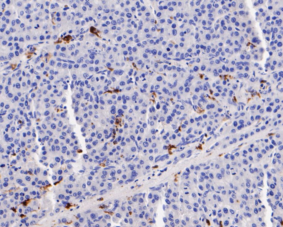Fig5:; Immunohistochemical analysis of paraffin-embedded human hepatic carcinoma tissue using anti-CD68 antibody. The section was pre-treated using heat mediated antigen retrieval with Tris-EDTA buffer (pH 8.0-8.4) for 20 minutes.The tissues were blocked in 5% BSA for 30 minutes at room temperature, washed with ddH; 2; O and PBS, and then probed with the primary antibody ( 1/200) for 30 minutes at room temperature. The detection was performed using an HRP conjugated compact polymer system. DAB was used as the chromogen. Tissues were counterstained with hematoxylin and mounted with DPX.