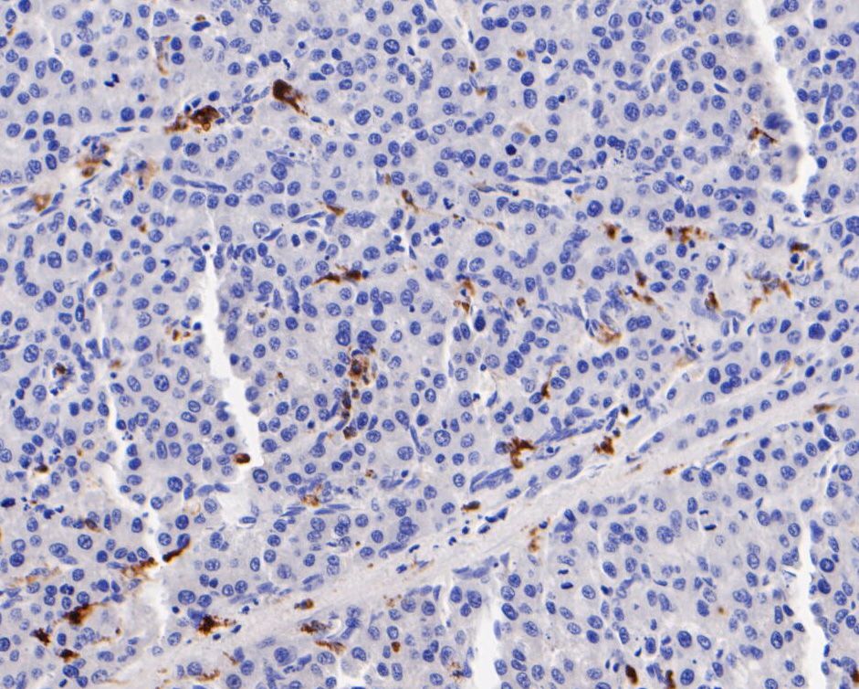 Fig5:; Immunohistochemical analysis of paraffin-embedded human hepatic carcinoma tissue using anti-CD68 antibody. The section was pre-treated using heat mediated antigen retrieval with Tris-EDTA buffer (pH 8.0-8.4) for 20 minutes.The tissues were blocked in 5% BSA for 30 minutes at room temperature, washed with ddH; 2; O and PBS, and then probed with the primary antibody ( 1/200) for 30 minutes at room temperature. The detection was performed using an HRP conjugated compact polymer system. DAB was used as the chromogen. Tissues were counterstained with hematoxylin and mounted with DPX.