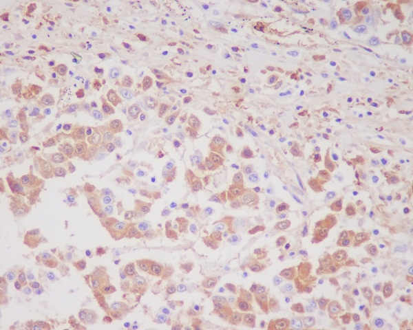 Immunohistochemical analysis of paraffin-embedded human colon cancer, using MMP9 Antibody.