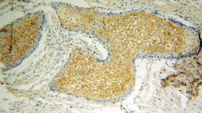 Immunohistochemical of paraffin-embedded human osteosarcoma using Catalog No:108883(SLC7A1 antibody) at dilution of 1:100 (under 10x lens)