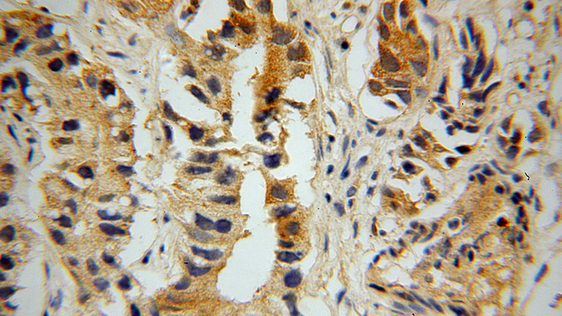 Immunohistochemical of paraffin-embedded human gliomas using Catalog No:113976(PNMA1 antibody) at dilution of 1:100 (under 40x lens)