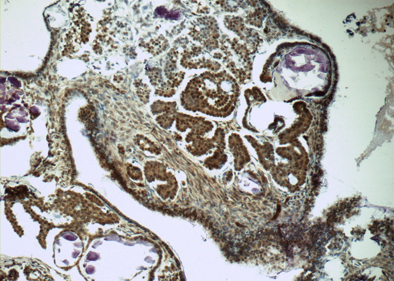 Immunohistochemistry of paraffin-embedded human ovary tumor tissue slide using Catalog No:115570(SPIN1 Antibody) at dilution of 1:50 (under 10x lens)