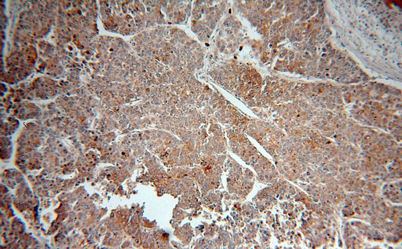Immunohistochemical of paraffin-embedded human liver cancer using Catalog No:107988(AMBRA1 antibody) at dilution of 1:50 (under 10x lens)