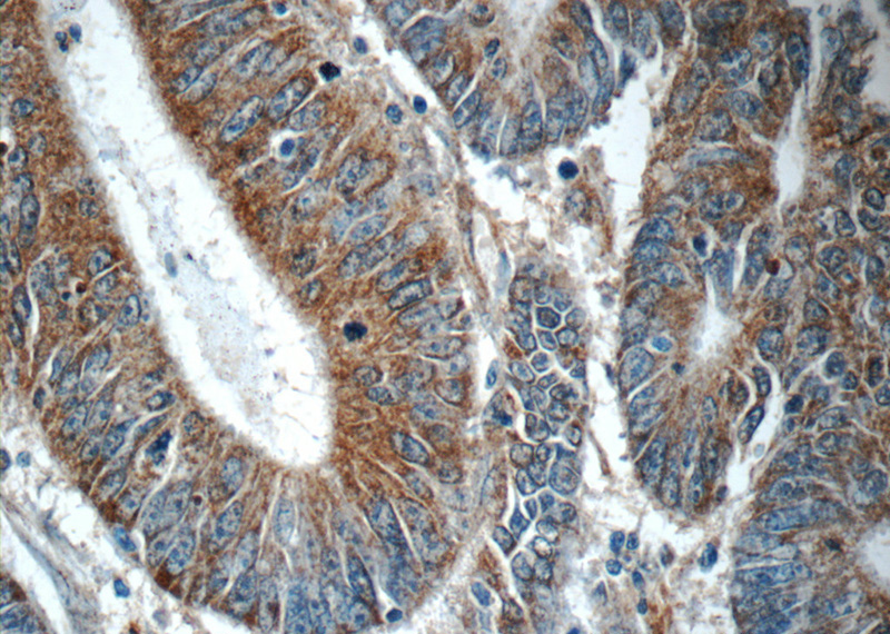 Immunohistochemistry of paraffin-embedded human colon cancer tissue slide using Catalog No:113826(PHLPPL Antibody) at dilution of 1:50 (under 40x lens)