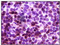 Immunohistochemical analysis of paraffin-embedded human lymph tumor, showing cytoplasmic localization using ZAP70 mouse mAb with DAB staining