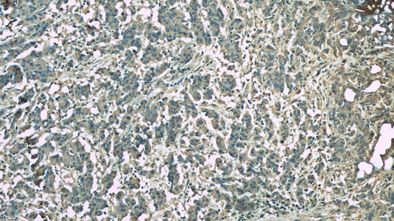 Immunohistochemistry of paraffin-embedded human prostate cancer slide using Catalog No:107216(FKBP2 Antibody) at dilution of 1:50