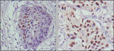 Immunohistochemical analysis of paraffin-embedded human esophageal cancer (left) and lung cancer (right), showing nuclear localization using p53 mouse mAb with DAB staining.