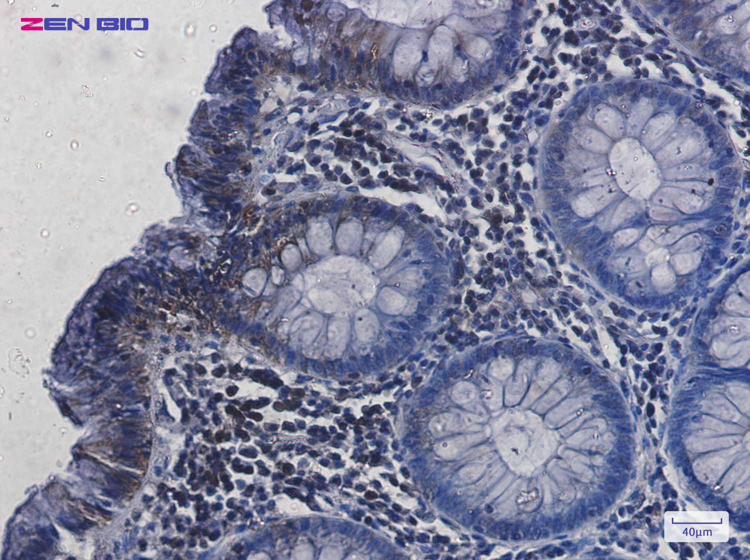Immunohistochemistry of Hsc70 in paraffin-embedded Human colon cancer tissue using Hsc70 Rabbit pAb at dilution 1/20