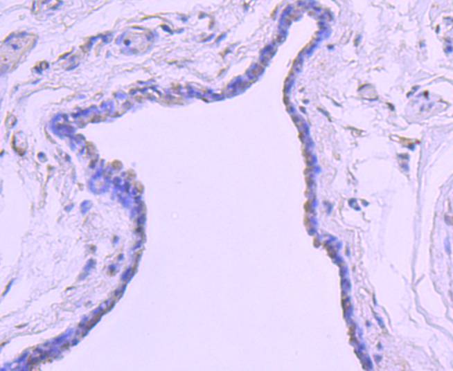 Fig5:; Immunohistochemical analysis of paraffin-embedded human breast carcinoma tissue using anti-Histone H2B(mono methyl R79) antibody. Counter stained with hematoxylin.