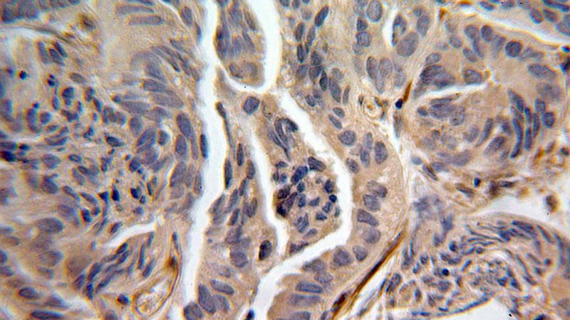 Immunohistochemical of paraffin-embedded human prostate cancer using Catalog No:116526(UBE2G2 antibody) at dilution of 1:100 (under 25x lens)