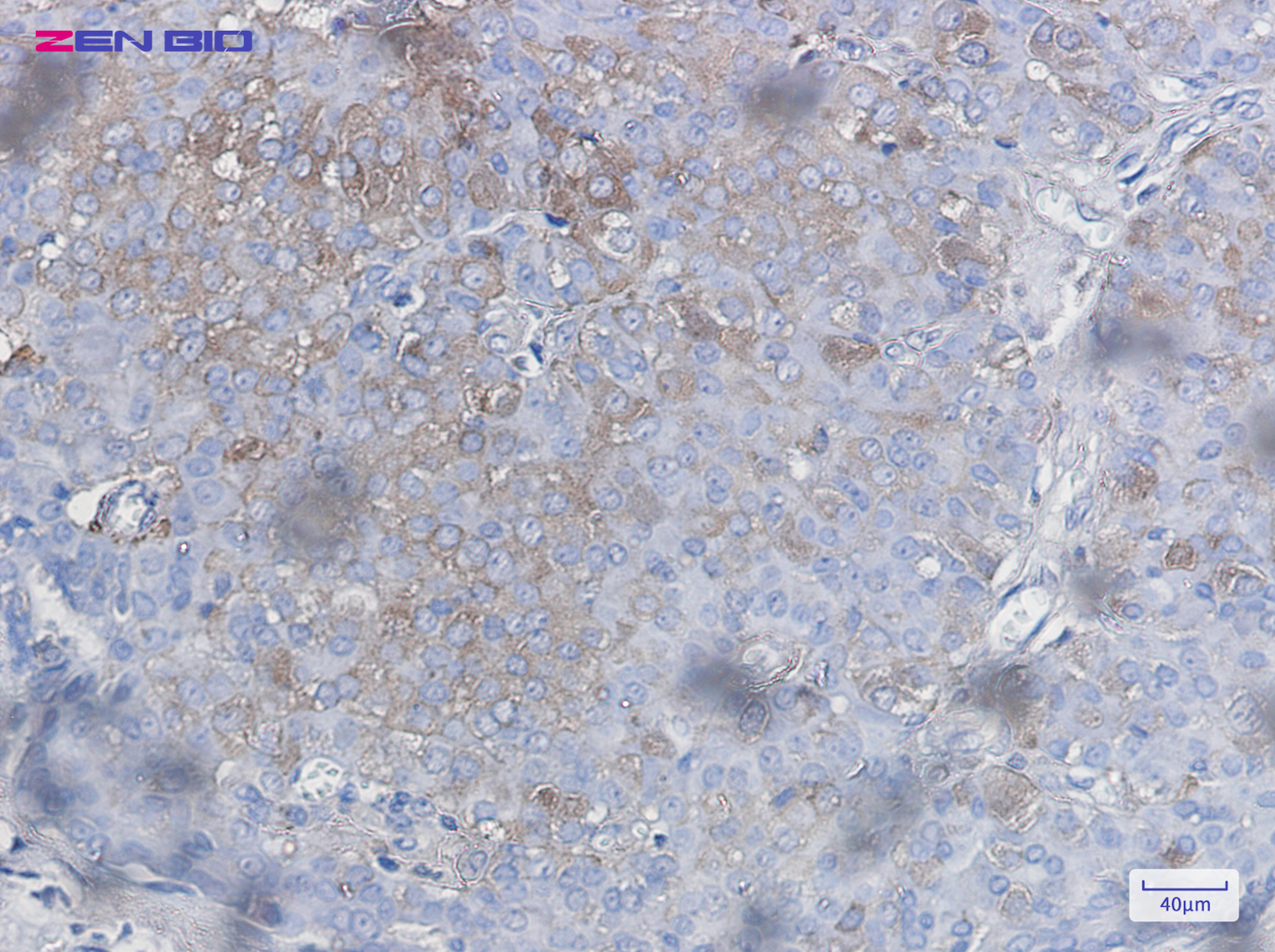 Immunohistochemistry of Bad in paraffin-embedded Human breast cancer tissue using Bad Rabbit pAb at dilution 1/50