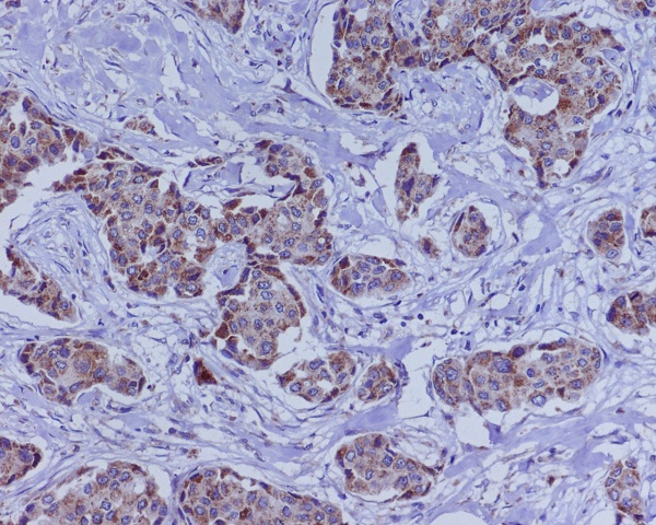 Immunohistochemical analysis of paraffin-embedded human breast cancer, using BMP4 Antibody.