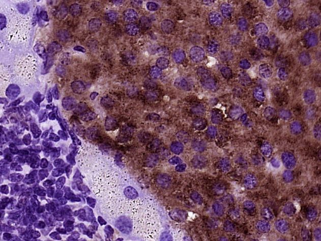 Fig2: Paraformaldehyde-fixed, paraffin embedded (Mouse pancreas); Antigen retrieval by boiling in sodium citrate buffer (pH6.0) for 15min; Block endogenous peroxidase by 3% hydrogen peroxide for 20 minutes; Blocking buffer (normal goat serum) at 37℃ for 30min; Antibody incubation with (BTBD17) Polyclonal Antibody, Unconjugated at 1:400 overnight at 4℃, followed by operating according to SP Kit(Rabbit) (sp-0023) instructionsand DAB staining.