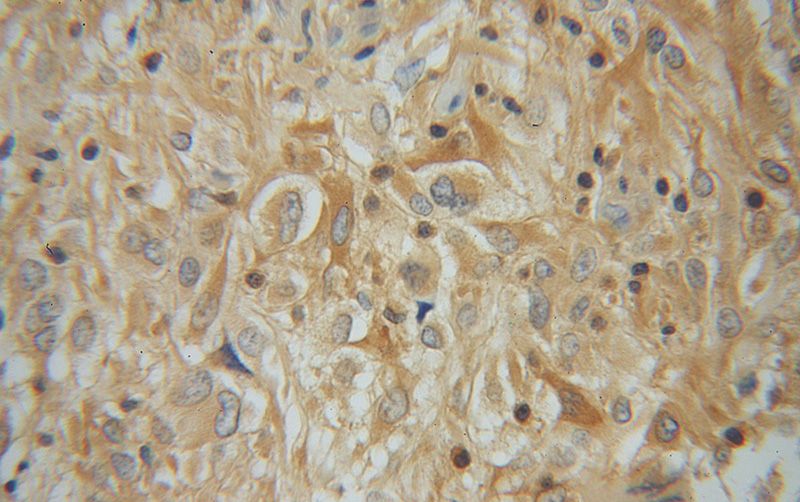 Immunohistochemical of paraffin-embedded human gliomas using Catalog No:112142(LAP3 antibody) at dilution of 1:50 (under 40x lens)