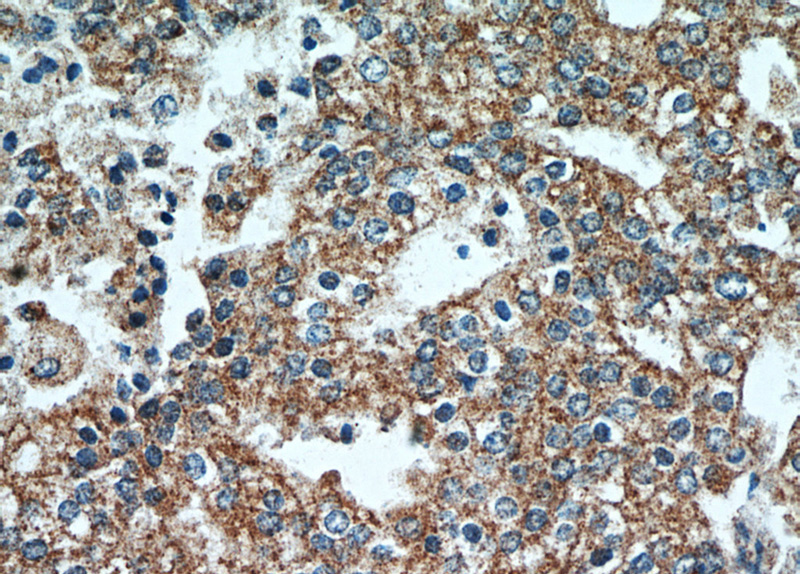 Immunohistochemical of paraffin-embedded human prostate cancer using Catalog No:113352(OPLAH antibody) at dilution of 1:50 (under 40x lens)