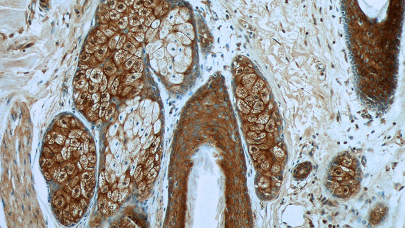 Immunohistochemistry of paraffin-embedded human skin cancer tissue slide using Catalog No:108235(ARAF Antibody) at dilution of 1:50 (under 10x lens)