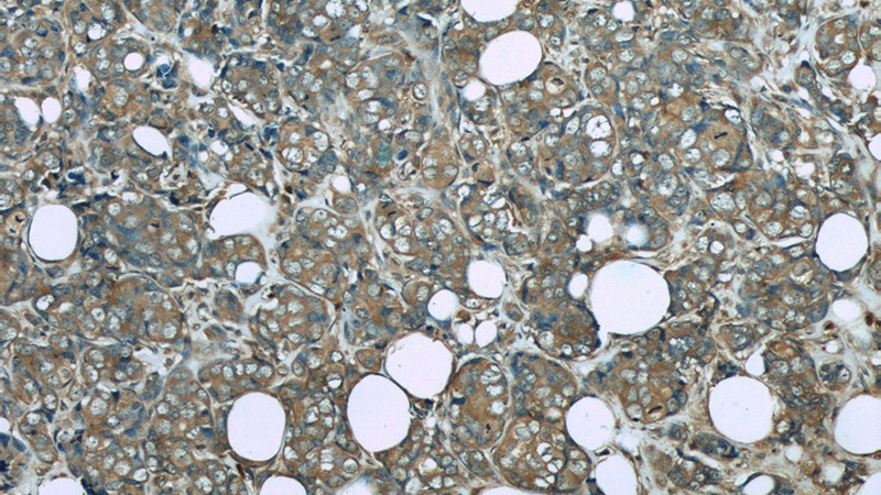 Immunohistochemistry of paraffin-embedded human breast cancer slide using Catalog No:107444(P4HA1 Antibody) at dilution of 1:50