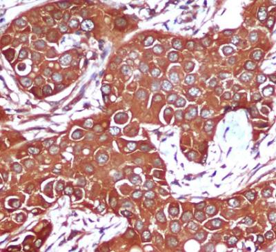 Immunohistochemical analysis of paraffin-embedded Breast cancer using AMPK beta 1 mouse mAb (1/200 dilution).Antigen retrieval was performed by pressure cooking in citrate buffer (pH 6.0).