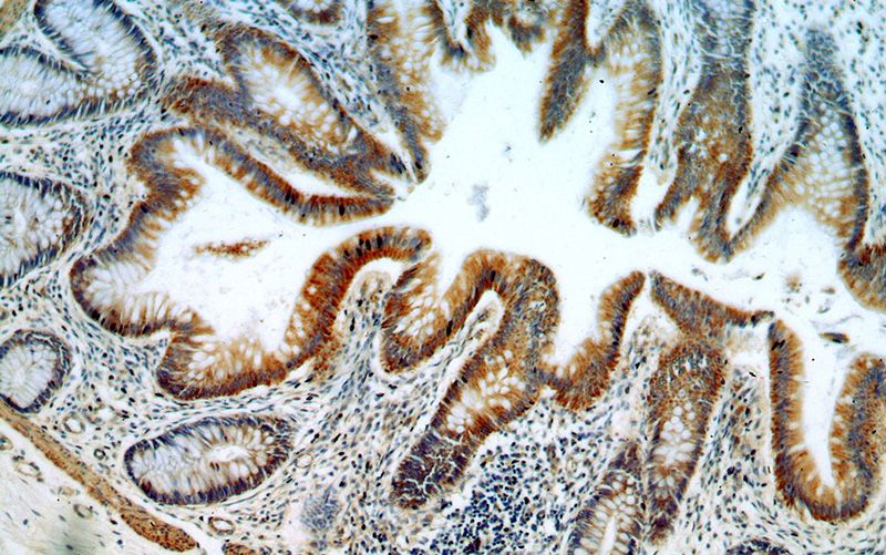 Immunohistochemical of paraffin-embedded human colon using Catalog No:113849(PRKCD antibody) at dilution of 1:100 (under 10x lens)