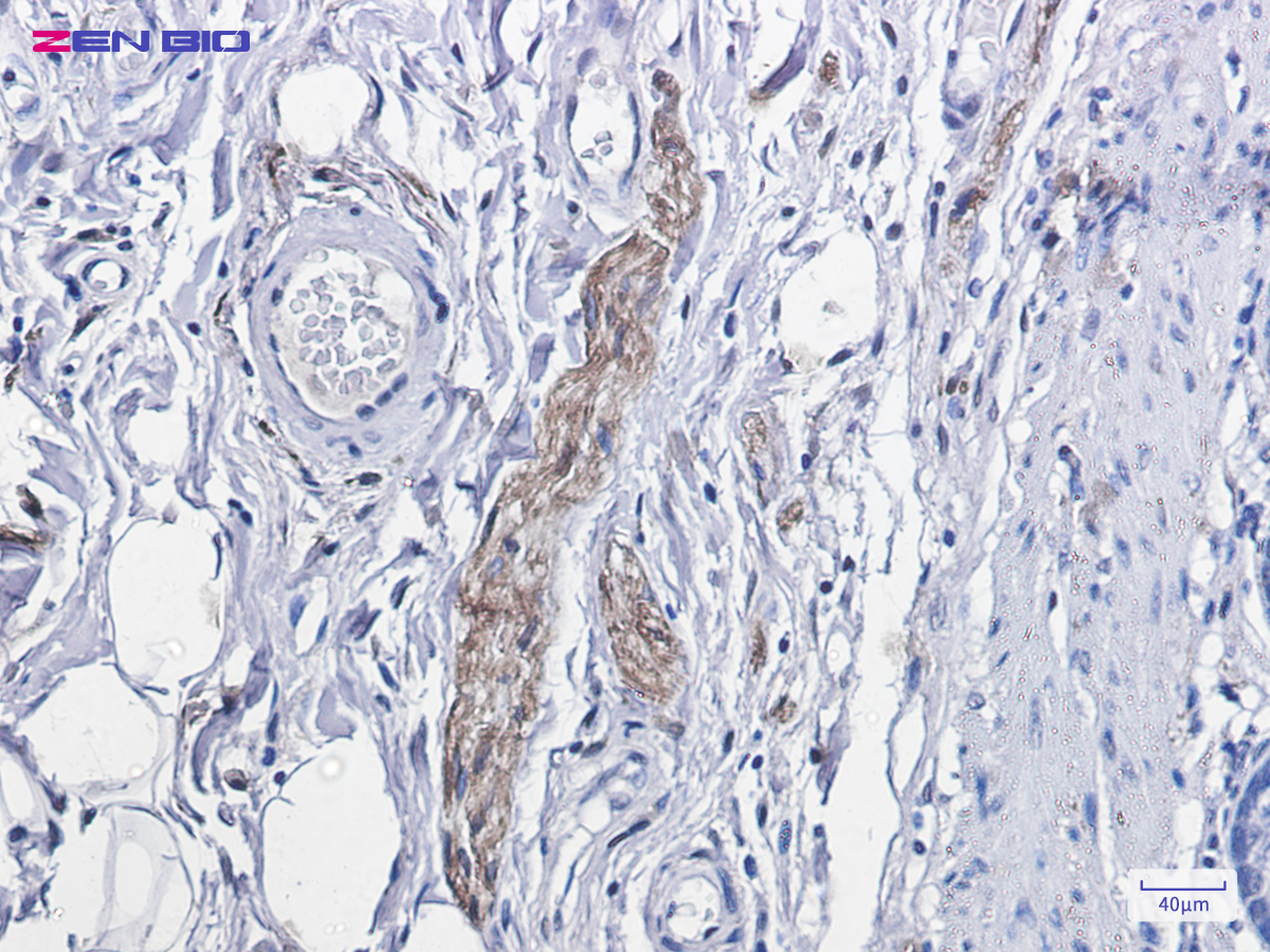 Immunohistochemistry of Phospho-PKC alpha (Thr638) in paraffin-embedded human colon cancer tissue using Phospho-PKC alpha (Thr638) Rabbit mAb at dilution 1/100