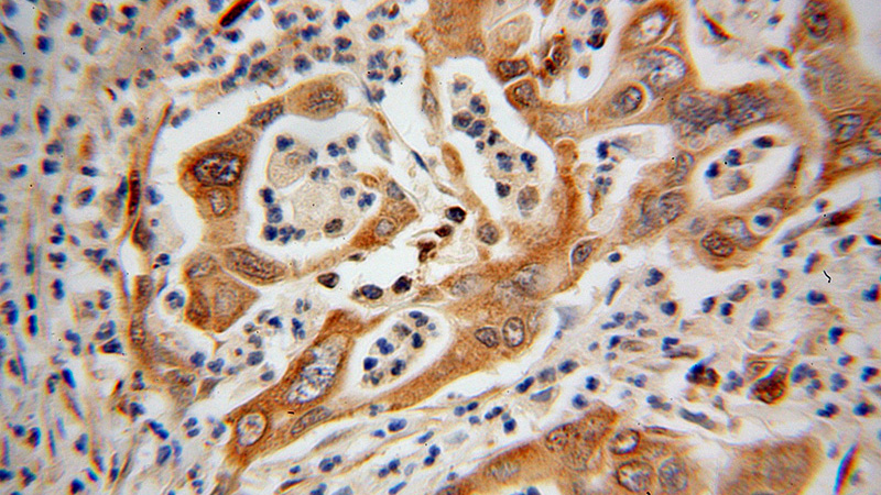 Immunohistochemical of paraffin-embedded human pancreas cancer using Catalog No:111944(ISYNA1 antibody) at dilution of 1:100 (under 40x lens)