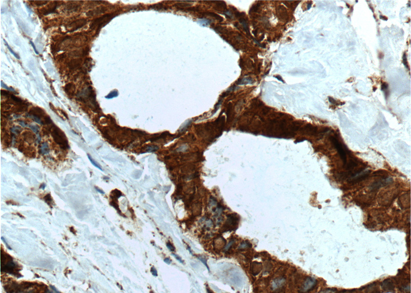 Immunohistochemistry of paraffin-embedded human breast cancer tissue slide using Catalog No:115827(SULT1A4 Antibody) at dilution of 1:200 (under 40x lens). heat mediated antigen retrieved with Tris-EDTA buffer(pH9).