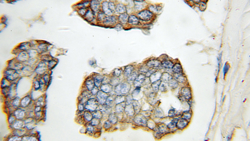 Immunohistochemical of paraffin-embedded human breast cancer using Catalog No:112209(DHX58 antibody) at dilution of 1:10 (under 10x lens)