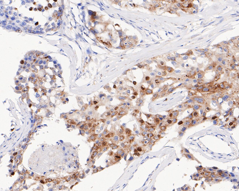 Fig7:; Immunohistochemical analysis of paraffin-embedded human breast carcinoma tissue using anti-Phospho-Histone H1.3(T17)+Histone H1.4(T17) antibody. The section was pre-treated using heat mediated antigen retrieval with sodium citrate buffer (pH 6.0) for 20 minutes. The tissues were blocked in 5% BSA for 30 minutes at room temperature, washed with ddH; 2; O and PBS, and then probed with the primary antibody ( 1/200) for 30 minutes at room temperature. The detection was performed using an HRP conjugated compact polymer system. DAB was used as the chromogen. Tissues were counterstained with hematoxylin and mounted with DPX.