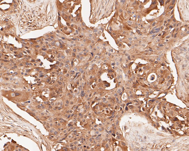 Fig5:; Immunohistochemical analysis of paraffin-embedded human breast carcinoma tissue using anti-TMX4 antibody. The section was pre-treated using heat mediated antigen retrieval with Tris-EDTA buffer (pH 8.0-8.4) for 20 minutes.The tissues were blocked in 5% BSA for 30 minutes at room temperature, washed with ddH; 2; O and PBS, and then probed with the primary antibody ( 1/50) for 30 minutes at room temperature. The detection was performed using an HRP conjugated compact polymer system. DAB was used as the chromogen. Tissues were counterstained with hematoxylin and mounted with DPX.