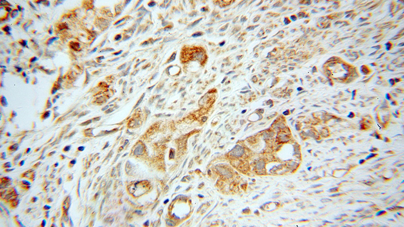 Immunohistochemical of paraffin-embedded human endometrial cancer using Catalog No:112057(KNG1 antibody) at dilution of 1:50 (under 40x lens)
