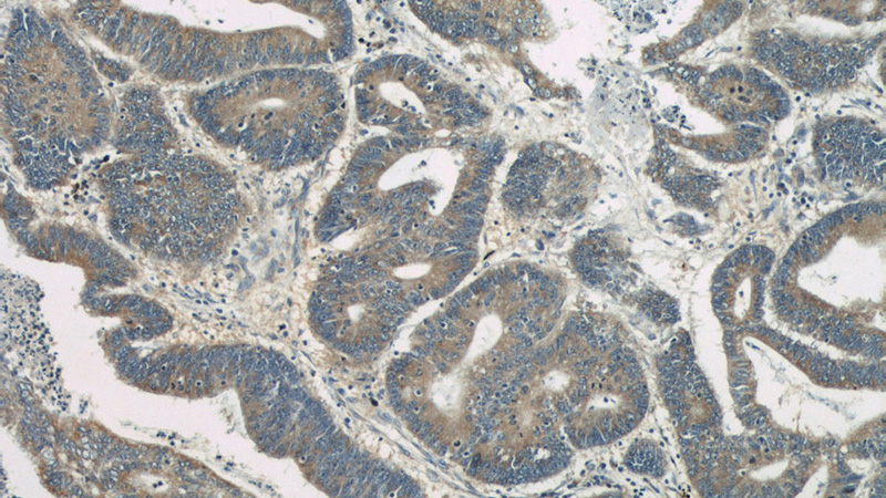 Immunohistochemical of paraffin-embedded human colon cancer using Catalog No:112188(LDLR antibody) at dilution of 1:50 (under 10x lens)