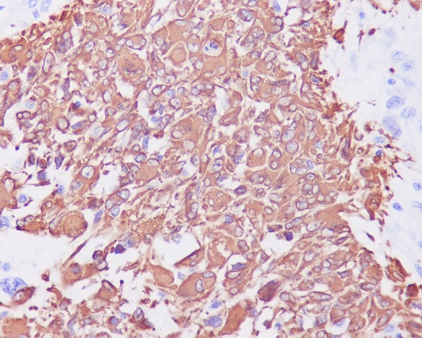 Immunohistochemical analysis of paraffin-embedded human glioma, using GFAP Antibody .