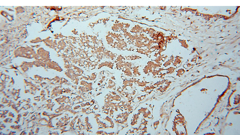 Immunohistochemical of paraffin-embedded human ovary tumor using Catalog No:117068(ATXN10 antibody) at dilution of 1:100 (under 10x lens)
