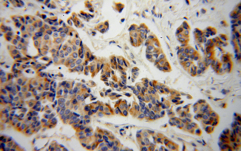 Immunohistochemical of paraffin-embedded human breast cancer using Catalog No:112261(KMO antibody) at dilution of 1:100 (under 40x lens)
