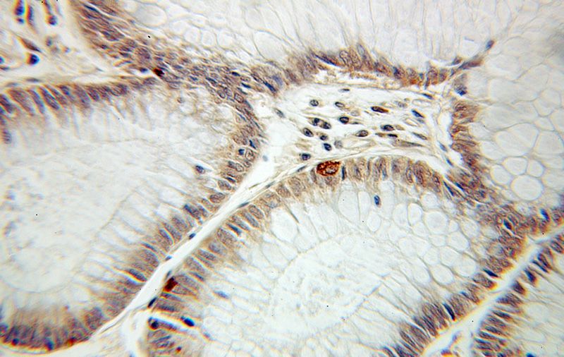 Immunohistochemical of paraffin-embedded human colon cancer using Catalog No:115565(SPHK1 antibody) at dilution of 1:100 (under 10x lens)