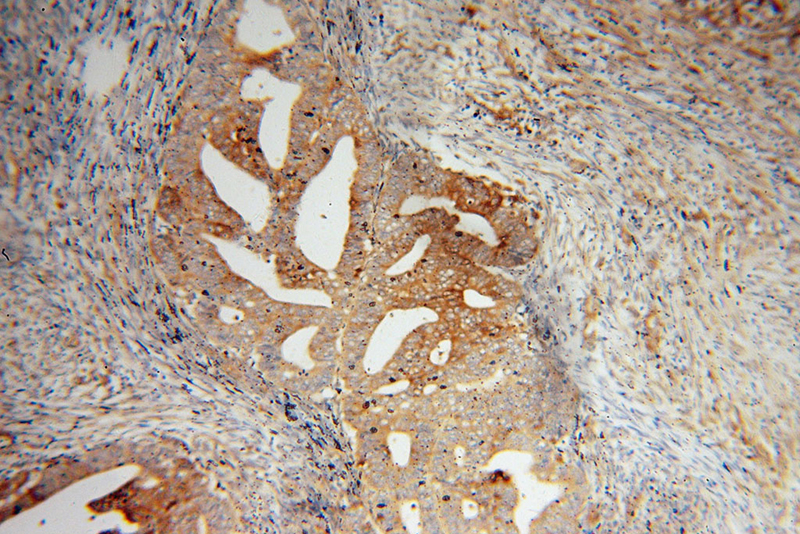 Immunohistochemical of paraffin-embedded human endometrial cancer using Catalog No:110891(GBP1 antibody) at dilution of 1:50 (under 10x lens)