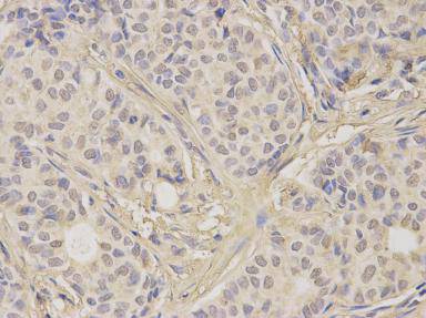 Fig2: Immunohistochemical analysis of paraffin-embedded human breast carcinoma tissue using anti- CD332 rabbit polyclonal antibody.