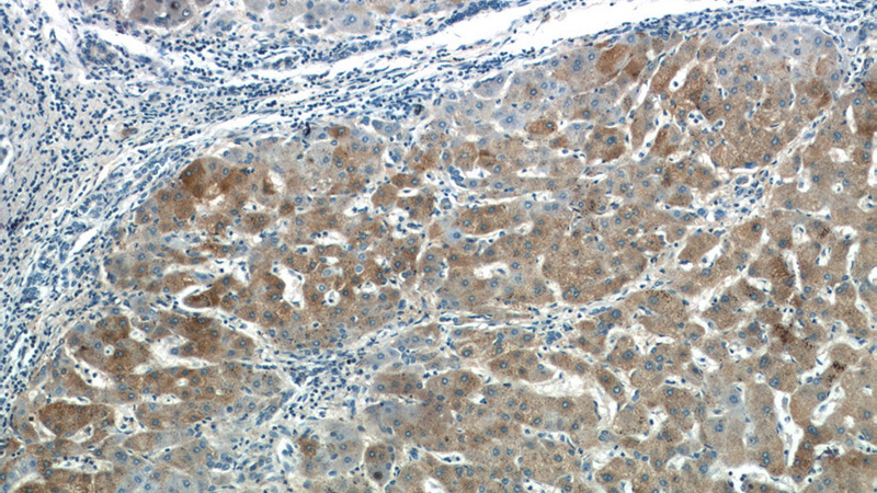 Immunohistochemistry of paraffin-embedded human hepatocirrhosis tissue slide using Catalog No:113571(PANK3 Antibody) at dilution of 1:50 (under 10x lens)