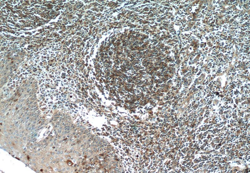 Immunohistochemistry of paraffin-embedded human tonsillitis tissue slide using Catalog No:109309(BIRC3 Antibody) at dilution of 1:50 (under 10x lens)