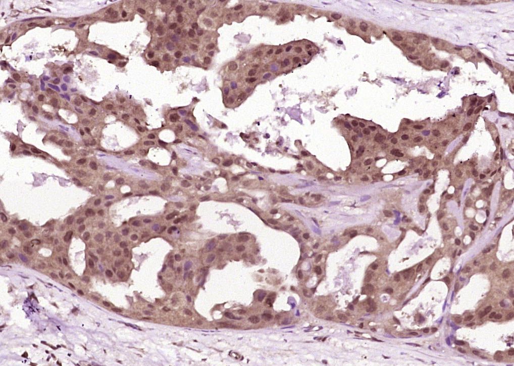 Fig1: Paraformaldehyde-fixed, paraffin embedded (Human breast carcinoma); Antigen retrieval by boiling in sodium citrate buffer (pH6.0) for 15min; Block endogenous peroxidase by 3% hydrogen peroxide for 20 minutes; Blocking buffer (normal goat serum) at 37℃ for 30min; Antibody incubation with (IL-1R2) Polyclonal Antibody, Unconjugated at 1:400 overnight at 4℃, followed by operating according to SP Kit(Rabbit) (sp-0023) instructionsand DAB staining.