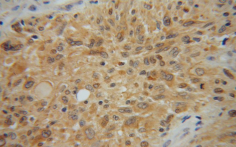 Immunohistochemical of paraffin-embedded human gliomas using Catalog No:113341(OLIG2 antibody) at dilution of 1:50 (under 40x lens)