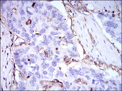 Immunohistochemical analysis of paraffin-embedded esophageal cancer tissues using B2M mouse mAb with DAB staining.