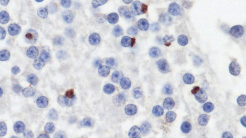 IHC results of GP-repeated antibody (Catalog No:111052, 1:500) with human cerebellum tissue (C9ORF72 expansion carrier) by Prof. Dr. Manuela Neumann. Staining conditions: Ventana automatic staining system using Optiview DAB detection kit; pretreatment boiling for 30min in citrate buffer pH6.