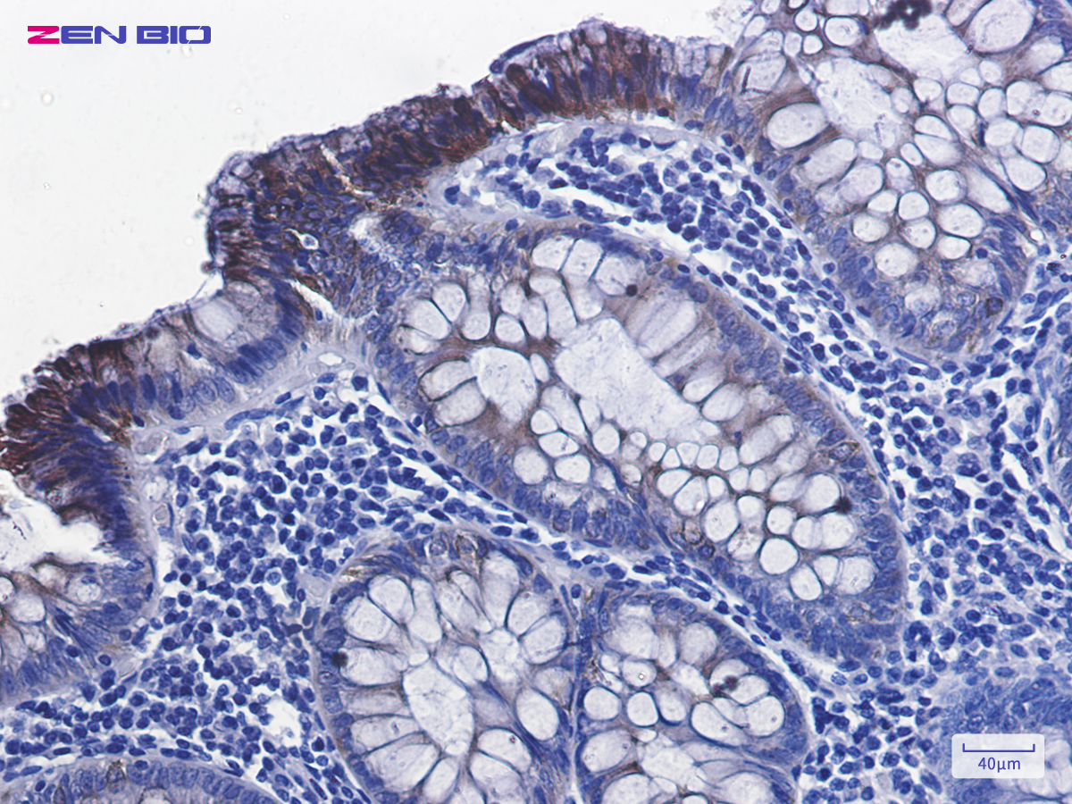 Immunohistochemistry of Phospho-GSK3 beta (Ser9) in paraffin-embedded human colon cancer tissue using Phospho-GSK3 beta (Ser9) Rabbit mAb at dilution 1/100
