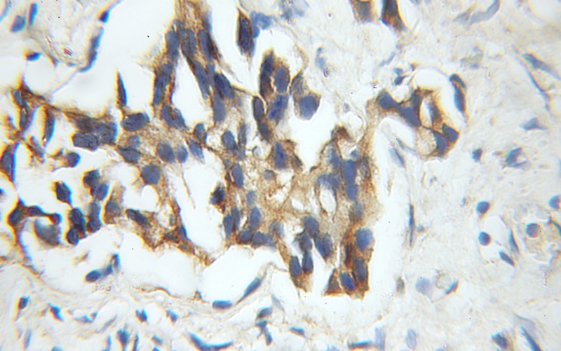 Immunohistochemical of paraffin-embedded human prostate cancer using Catalog No:116768(VPRBP antibody) at dilution of 1:50 (under 10x lens)