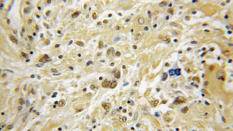 Immunohistochemical of paraffin-embedded human medulloblastoma using Catalog No:114194(PRKACB antibody) at dilution of 1:50 (under 10x lens)